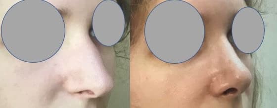 Rhinoplastie sans cicatrice externe - Recul, affinement et remontée de la pointe et suppression de la bosse (mars 2021)