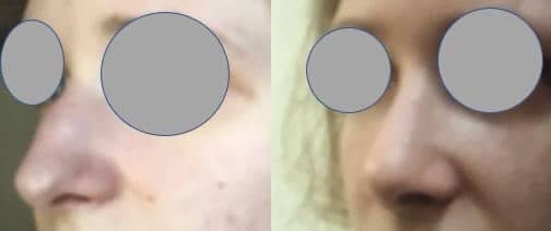 Rhinoplastie sans cicatrice externe - Recul, affinement et remontée de la pointe et suppression de la bosse (mars 2021)