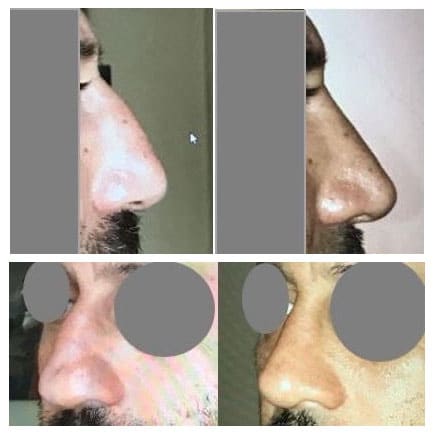 Rhinoplastie (octobre 2020)