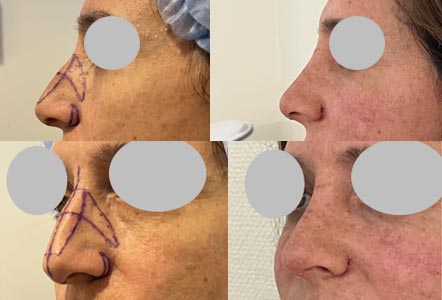 Rhinoplastie open - A 10 jours avec l'ablation de l'attelle