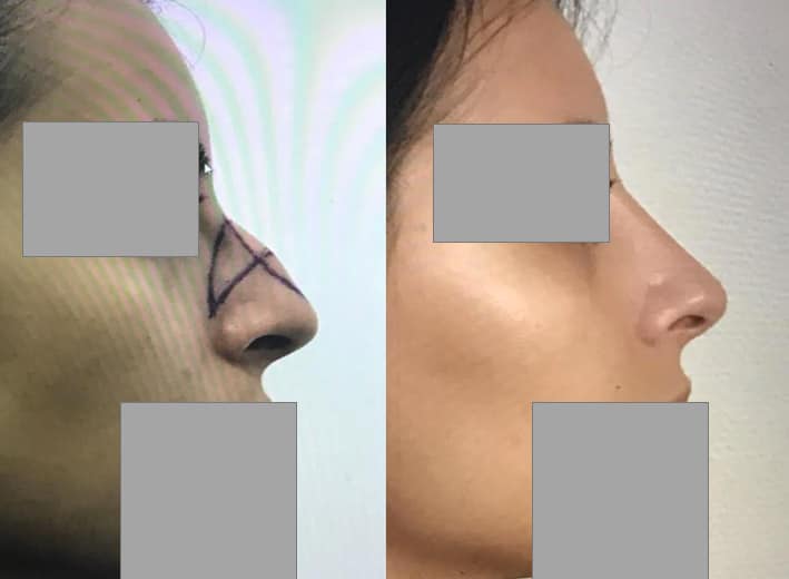 Rhinoplastie - Réduction de la bosse nasale (septembre 2018)