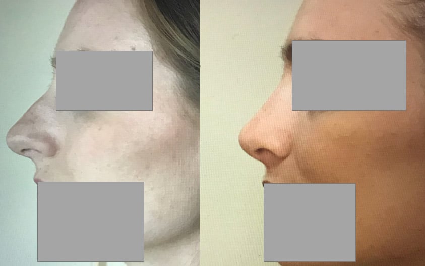 Rhinoplastie - Réduction des dimensions du nez dcm