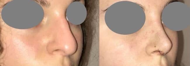 Rhinoplastie fermée pour réduction du nez - A 10 jours à l'ablation du plâtre