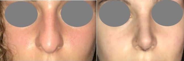 Rhinoplastie fermée pour réduction du nez - A 10 jours à l'ablation du plâtre