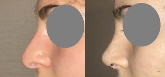 Rhinoplastie fermée pour réduction du nez - A 10 jours à l'ablation du plâtre