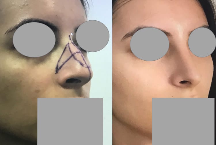 Rhinoplastie - Réduction de toutes les dimensions du nez dcm (septembre 2018)