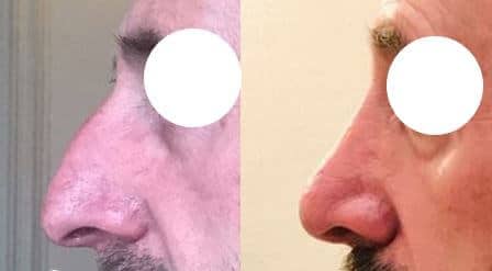 Rhinoplastie (septembre 2021)