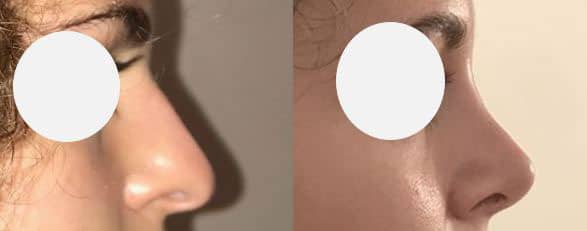 Rhinoplastie voie open - Affinement, relèvement et augmentation de la projection de la pointe du nez - Résection de la bosse (septembre 2021)