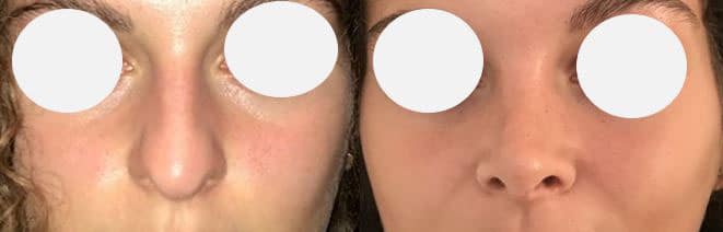 Rhinoplastie voie open - Affinement, relèvement et augmentation de la projection de la pointe du nez - Résection de la bosse (septembre 2021)