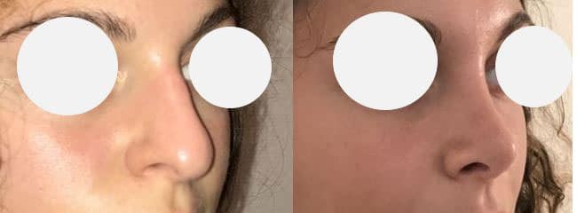 Rhinoplastie voie open - Affinement, relèvement et augmentation de la projection de la pointe du nez - Résection de la bosse (septembre 2021)