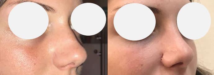 Rhinoplastie - Affinement et raccourcissement de la pointe - Réduction de l'arête nasale (septembre 2021)