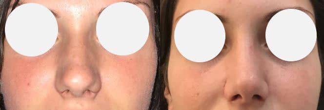 Rhinoplastie - Affinement et raccourcissement de la pointe - Réduction de l'arête nasale (septembre 2021)