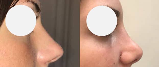 Rhinoplastie - Affinement et raccourcissement de la pointe - Réduction de l'arête nasale (septembre 2021)