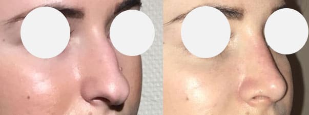Rhinoplastie - Suppression de la bosse et remontée de la pointe du nez (septembre 2021)