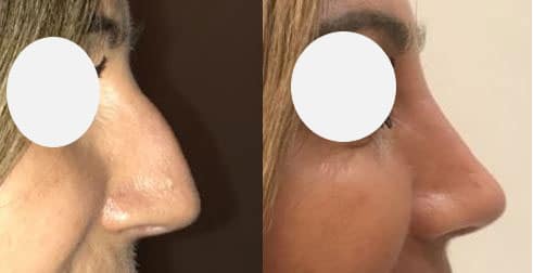 Rhinoplastie - Suppression de la bosse (septembre 2021)