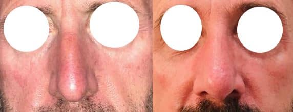 Rhinoplastie - Suppression de la bosse et remontée de la pointe du nez (septembre 2021)