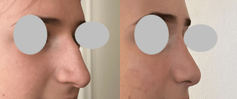 Rhinoplastie - Suppression de la bosse et remontée de la pointe nasale