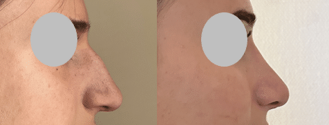 Rhinoplastie - Suppression de la bosse et remontée de la pointe nasale
