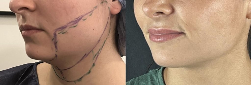 liposuccion du cou, du menton et joues