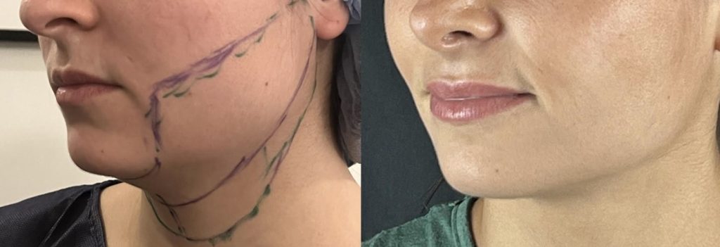 lipoaspiration du cou, du menton et joues