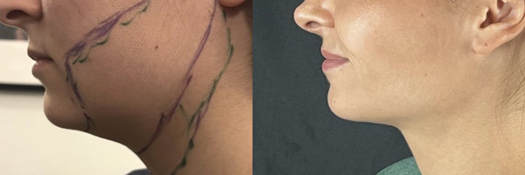 liposuccion du cou, du menton et joues