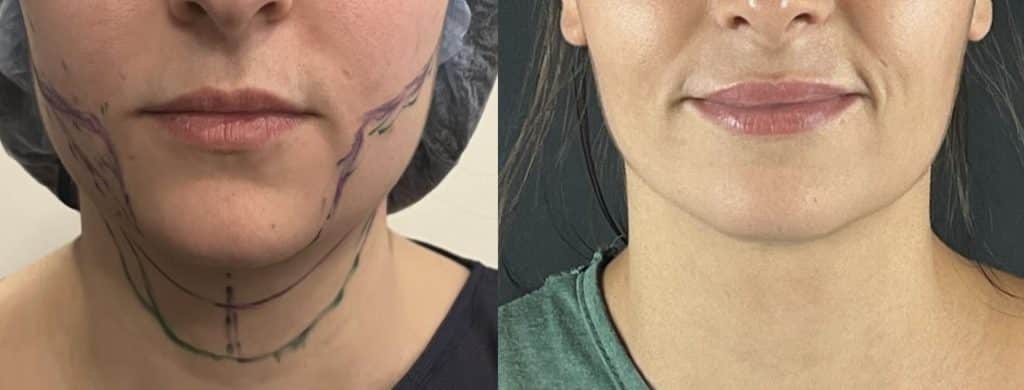 lipoaspiration du cou, du menton et joues