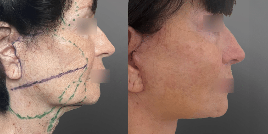 face-lift-bichectomie-et-resection-cordes-cervicales-a-6-jours-post-op-1-profil