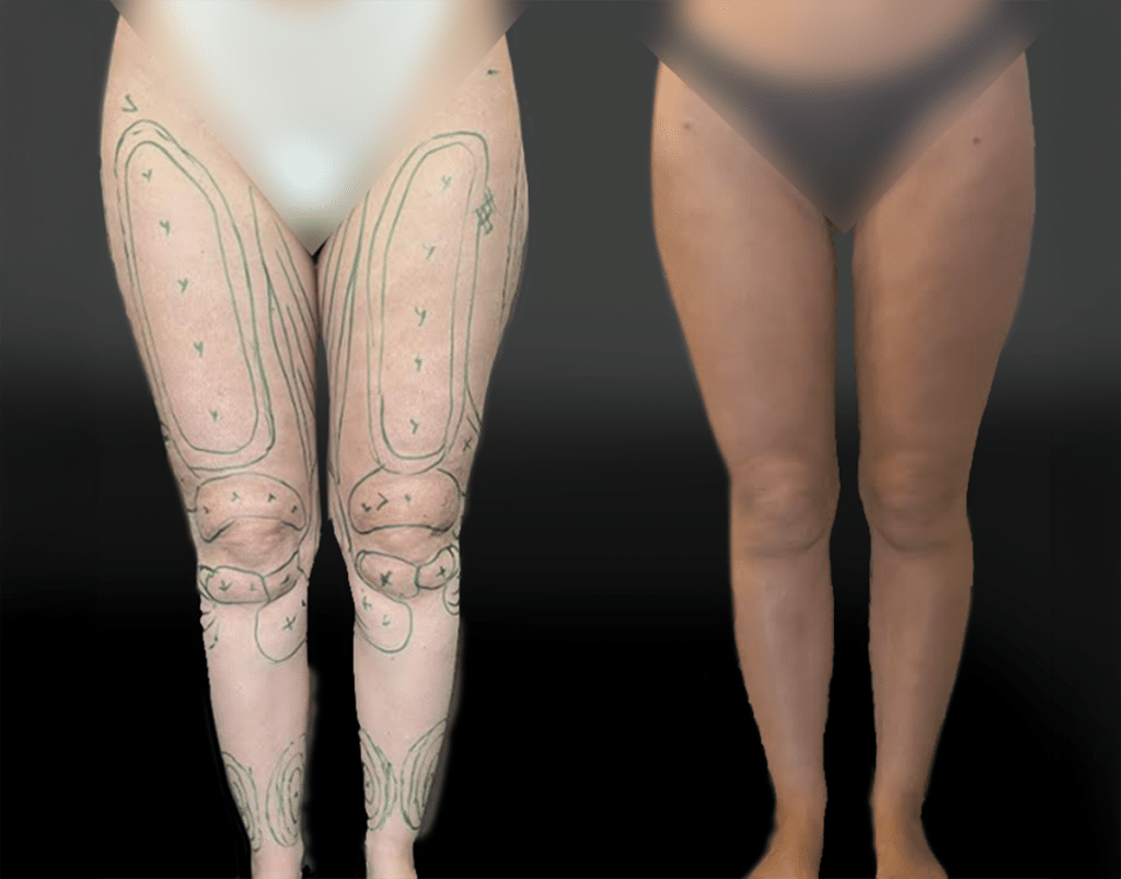 lipoaspiration-etendue-des-membres-inferieurs-1-face