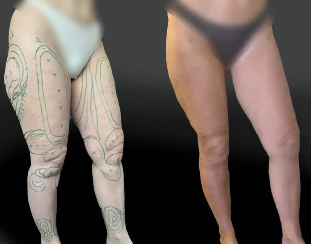 lipoaspiration-etendue-des-membres-inferieurs-1-trois-quart