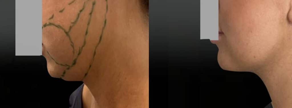 Lipoaspiration joues ovale et cou