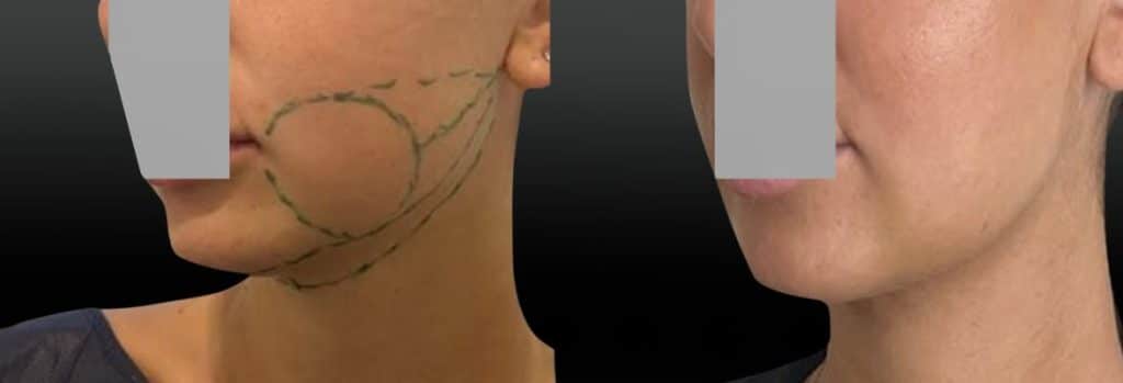 Lipoaspiration joues ovale et cou