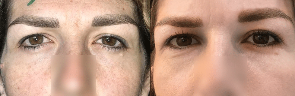 mask-lift-avec-canthopexie-trans-osseuse-2