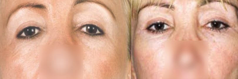 mask-lift-avec-canthopexie-trans-osseuse-3