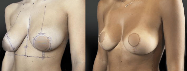 plastie-mammaire-pour-ptose-a-6-mois-post-op-1-trois-quart