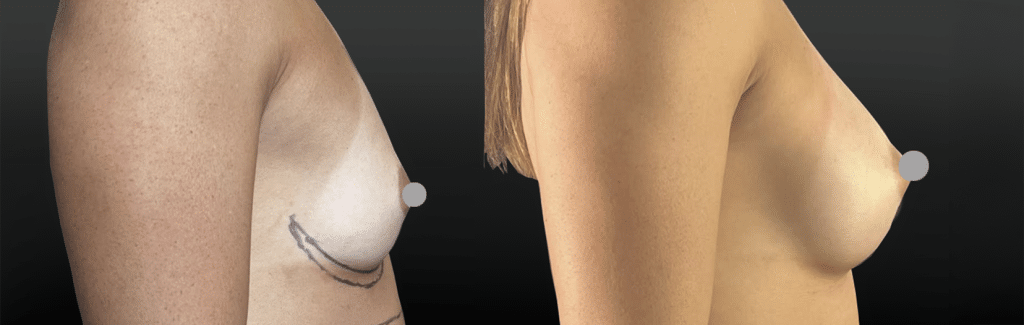 Implants mammaires en-position pré musculaire pour patiente sportive avec de gros pectoraux