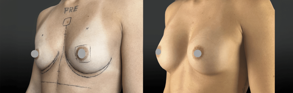 Implants mammaires en-position pré musculaire pour patiente sportive avec de gros pectoraux