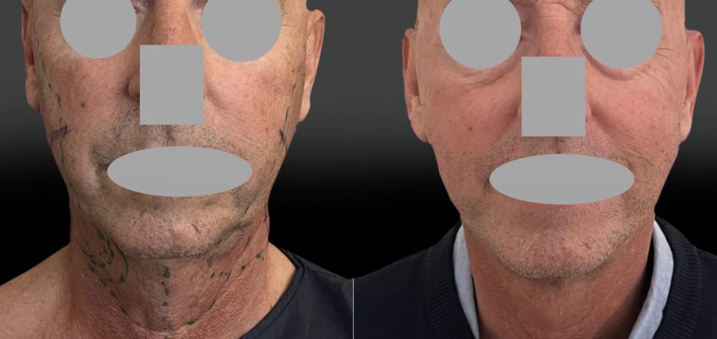 Lifting des joues, de l&rsquo;ovale et du cou, 6 jours post-op