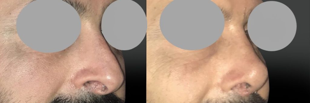 Rhinoplastie Homme