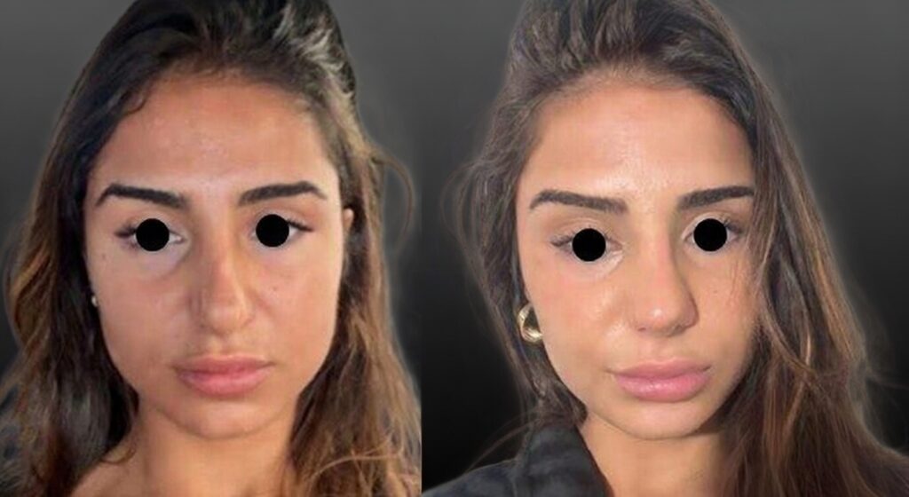 Injections de toxine botulique dans les masséters pour affinement de l'ovale du visage